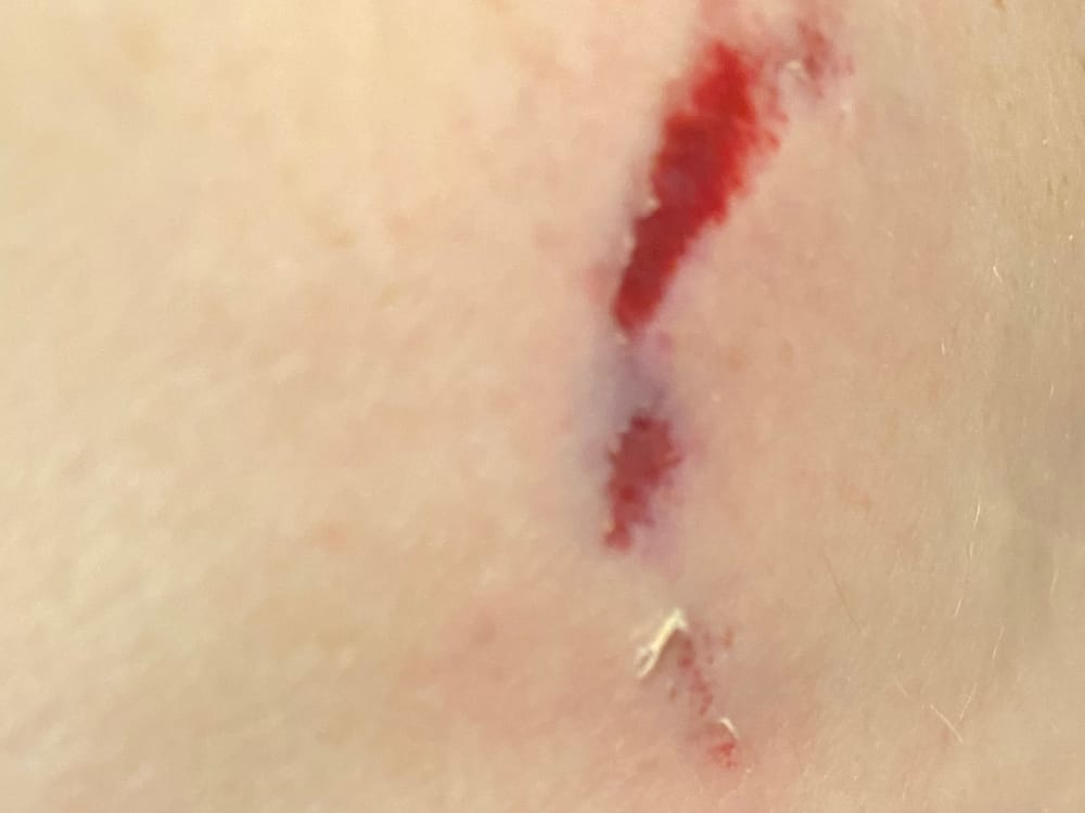 Dog bite post image